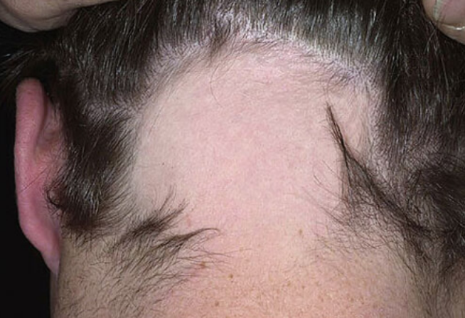 Male Pattern Baldness - Treatment and Causes | Guides