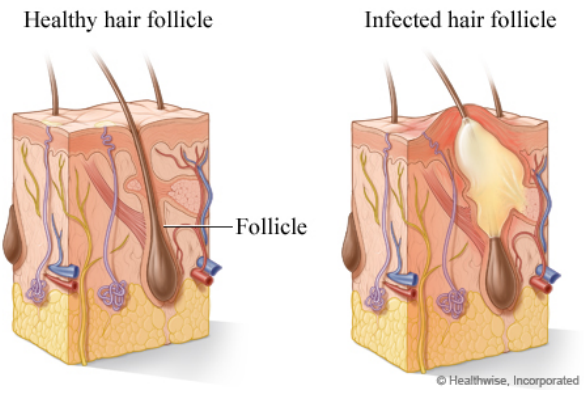 Hair follicles hurt and have a long white bulb : r/BeardAdvice