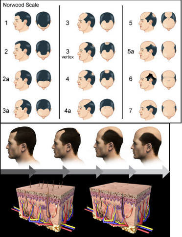 Hair Loss, Male Head with Hair Loss Symptoms Front Side Stock Image - Image  of health, hairstyle: 56233271