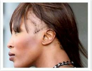 CCCA Hair Loss Treatment- Eternal Dermatology- Columbia MD