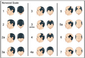 What is male pattern hair loss and can it be treated
