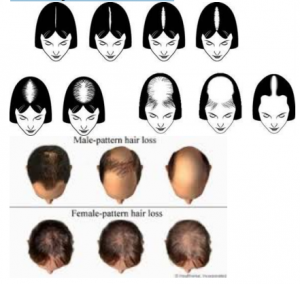 Female Pattern Baldness – Symptoms, Causes, and More