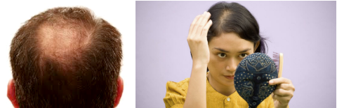 ZINC & HAIR LOSS GROWTH - My Hair Doctor | Prescription Haircare